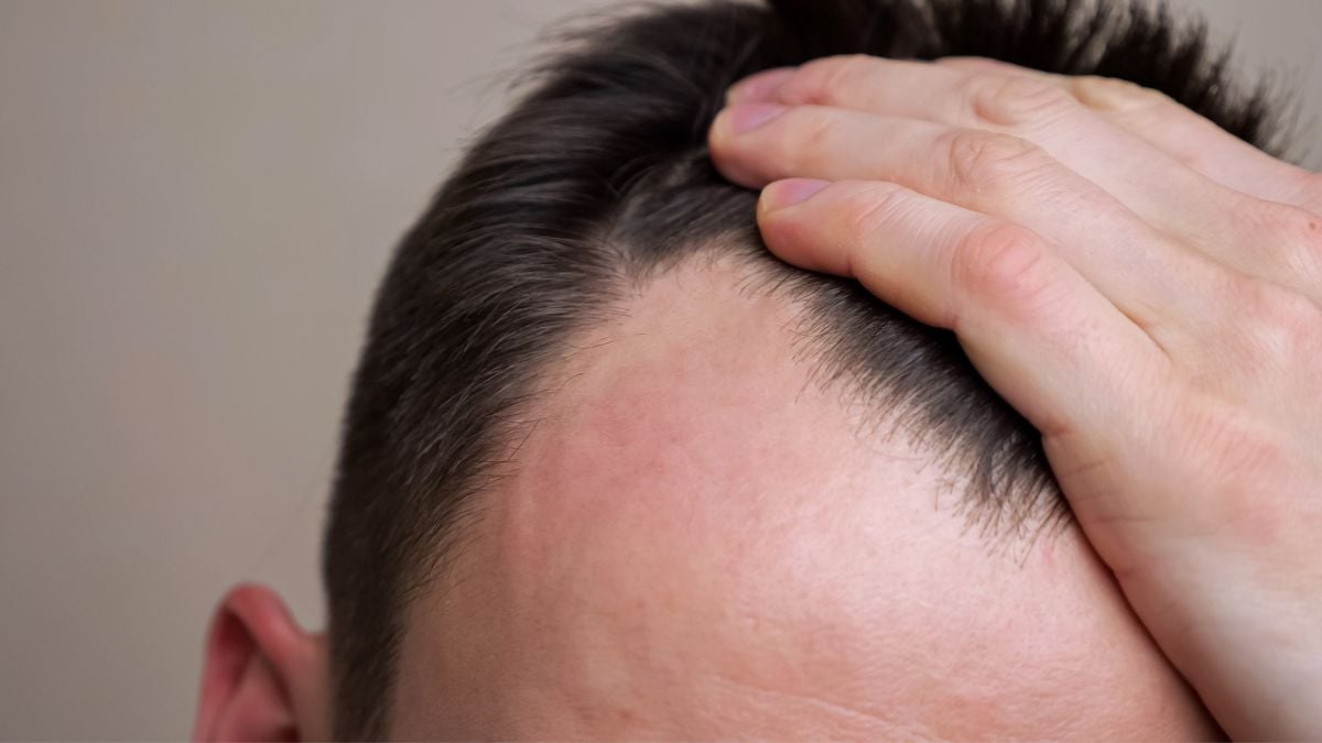 Calvitie : cette astuce prisée par les hommes permet de lutter contre la perte de cheveux !