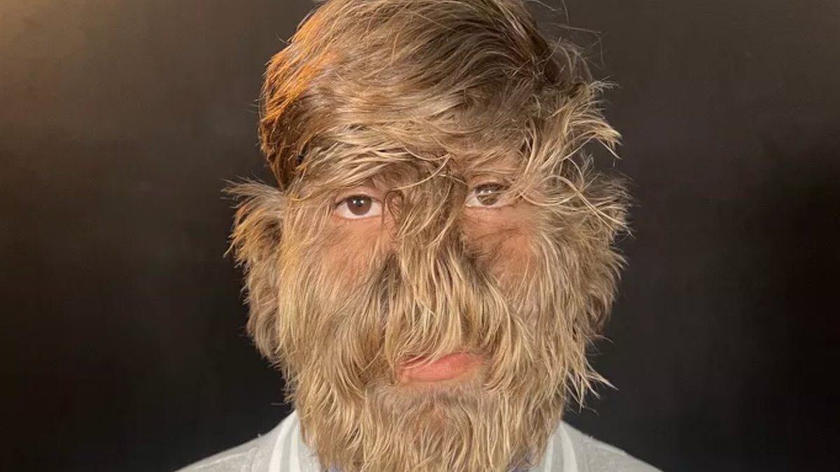 Atteint d'une maladie rare, cet ado de 18 ans décroche le record du visage le plus poilu au monde 