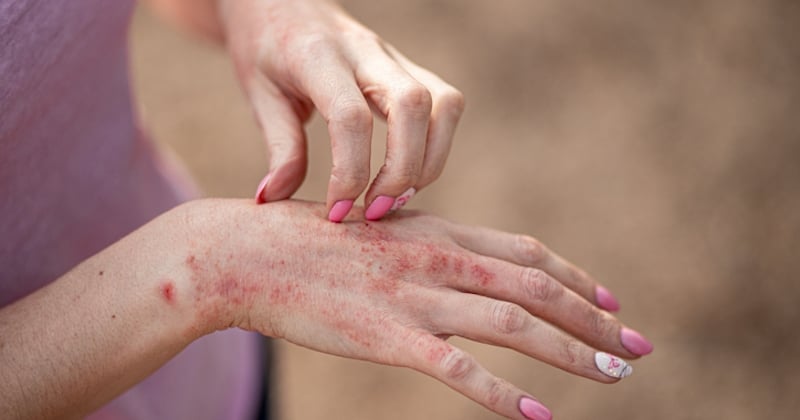 Très contagieuse, cette nouvelle maladie de peau inquiète les autorités sanitaires