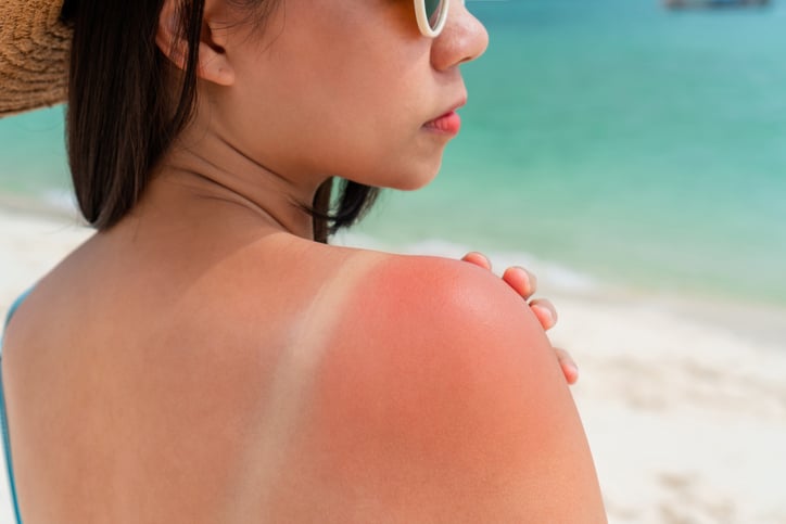 Une jeune femme, victime d'un coup de soleil à la plage, se tient l'épaule