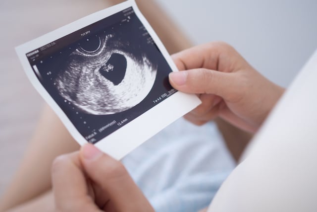 Une femme enceinte regarde une échographie de grossesse 