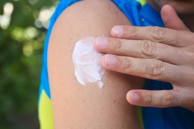 Une personne s'appliquant une crème pour soulager une piqûre de moustique